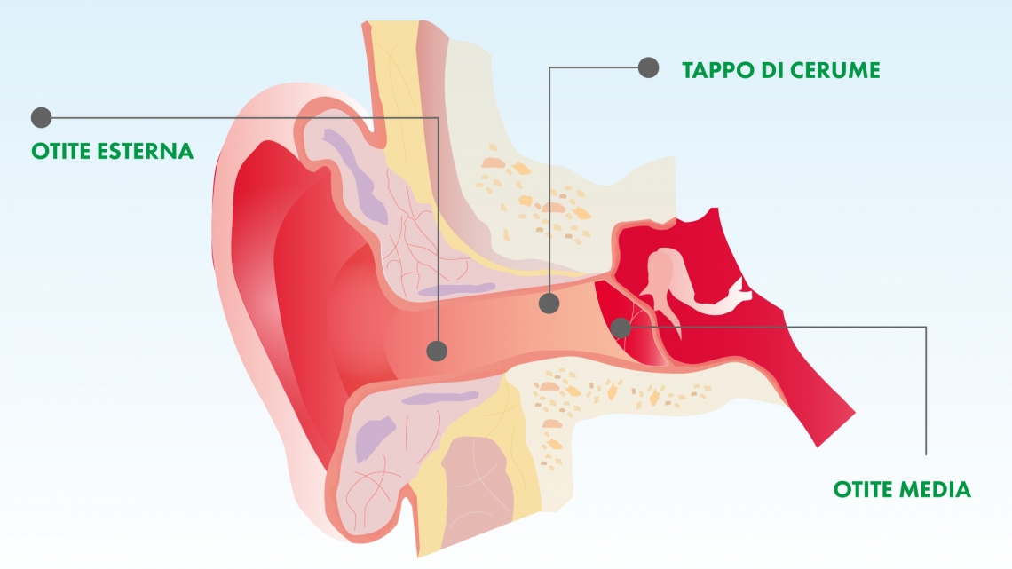 IMMAGINE tipologie otite